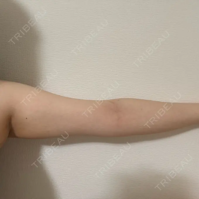 脂肪吸引（二の腕） Mods Clinic（モッズクリニック） 名古屋院 BEFORE メイン用