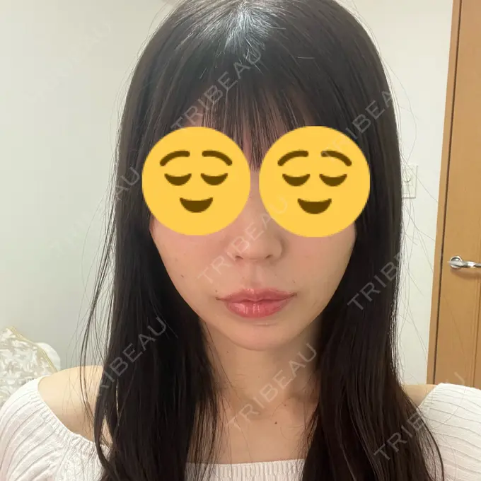 小鼻縮小（切開） / 人中短縮 / 鼻翼挙上 / ボトックス（ガミースマイル） Otus Clinic 【オータスクリニック】 BEFORE メイン用