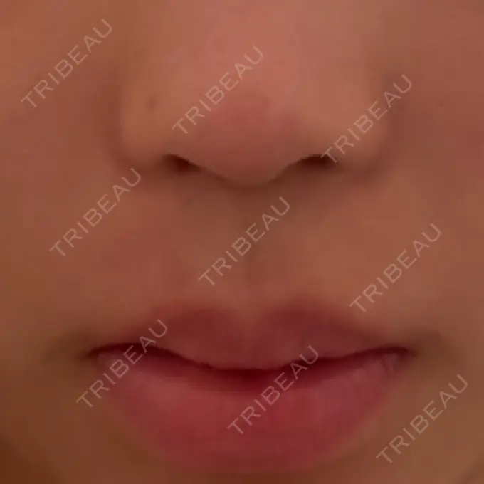 人中短縮 新宿ラクル美容外科クリニック 新宿院 BEFORE メイン用