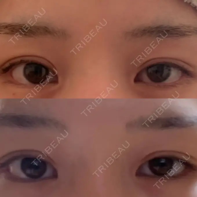 目頭切開 / 目尻切開 新宿ラクル美容外科クリニック 新宿院 BEFORE メイン用