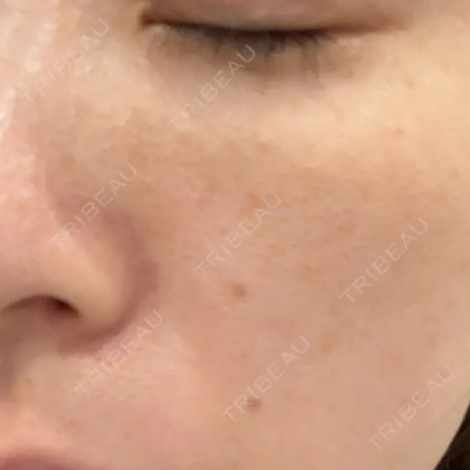 ピーリング（ニキビ・毛穴） 湘南美容クリニック 新橋銀座口院 BEFORE メイン用