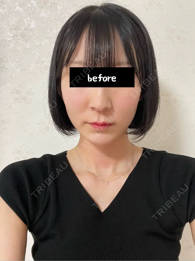 小鼻縮小（切開） / 人中短縮 / 鼻翼挙上 / 鼻翼基部形成（貴族手術） / 鼻柱下降・鼻唇角形成（猫手術） Otus Clinic 【オータスクリニック】 BEFORE メイン用