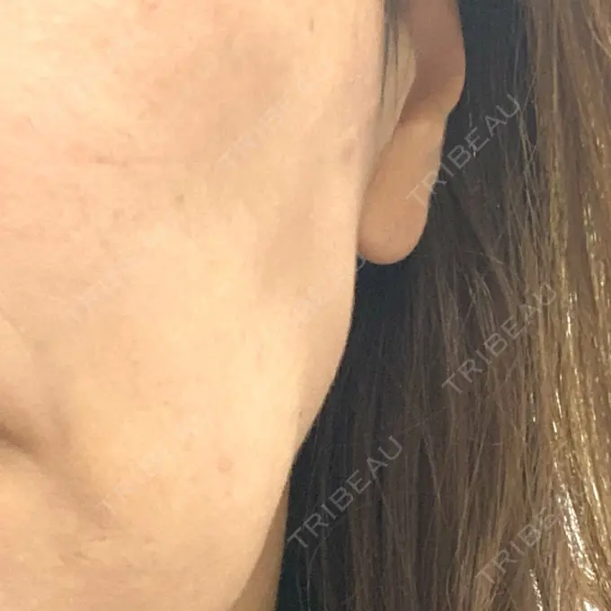 ボトックス（エラ・小顔） TCB東京中央美容外科 神戸院 BEFORE メイン用