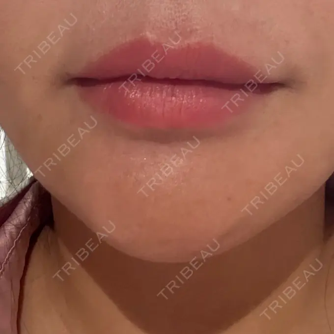 ボトックス（あご） / ボトックス（額） パルム美容クリニック BEFORE メイン用