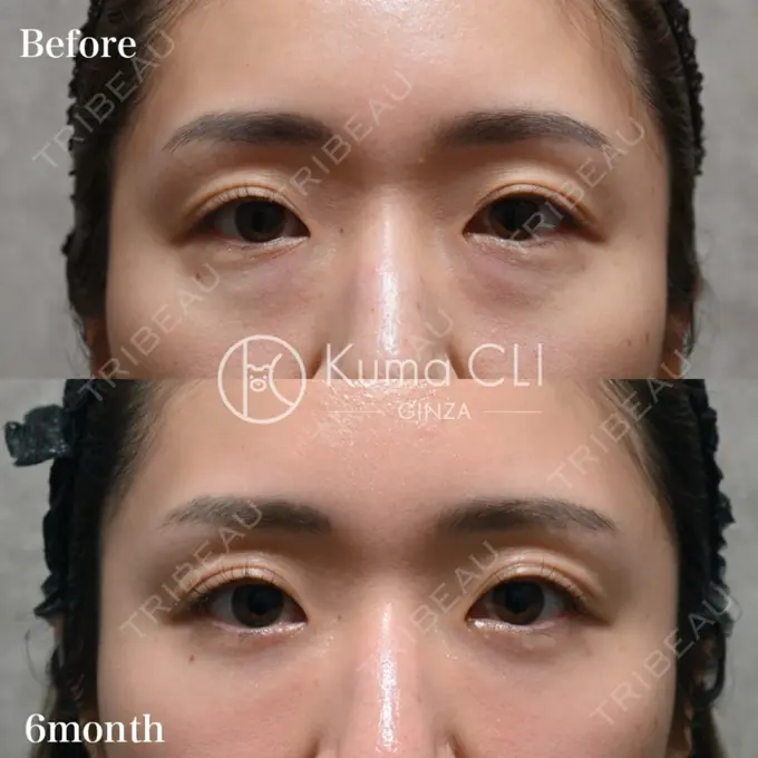 クマ治療 Kuma CLI 【クマクリ】 BEFORE メイン用