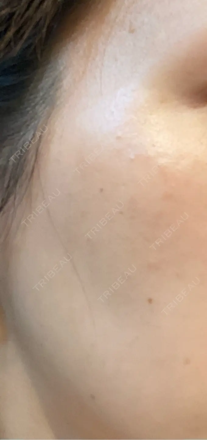 ピーリング（ニキビ・毛穴） / ルメッカ ルラ美容クリニック 静岡院 BEFORE メイン用