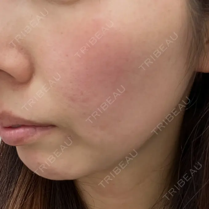 ピーリング（ニキビ・毛穴） / イオン導入 KM新宿クリニック BEFORE メイン用