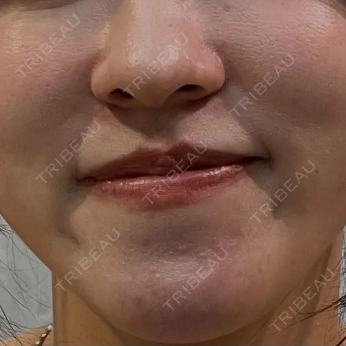 毛穴洗浄（ハイドラフェイシャルなど） 東京素肌クリニック 銀座本院 BEFORE メイン用