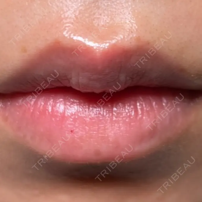 その他（口元） R Beauty CLINIC 銀座院 BEFORE メイン用