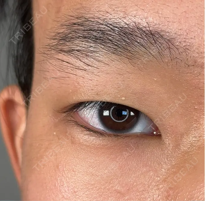 二重埋没 / 鼻尖形成（切開） / 口唇縮小術 / 目尻切開 / タレ目形成・グラマラスライン（切開） / 軟骨移植 / 眉間プロテーゼ アリエル美容クリニック 大宮院 BEFORE メイン用