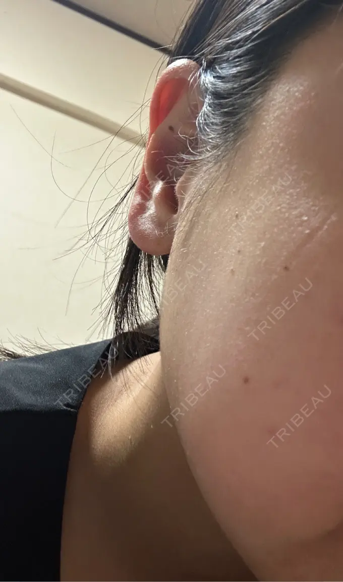 ボトックス（あご） / ボトックス（エラ・小顔） / 脂肪溶解注射（顔） / その他（鼻） Zetith Beauty Clinic 福岡院 BEFORE メイン用