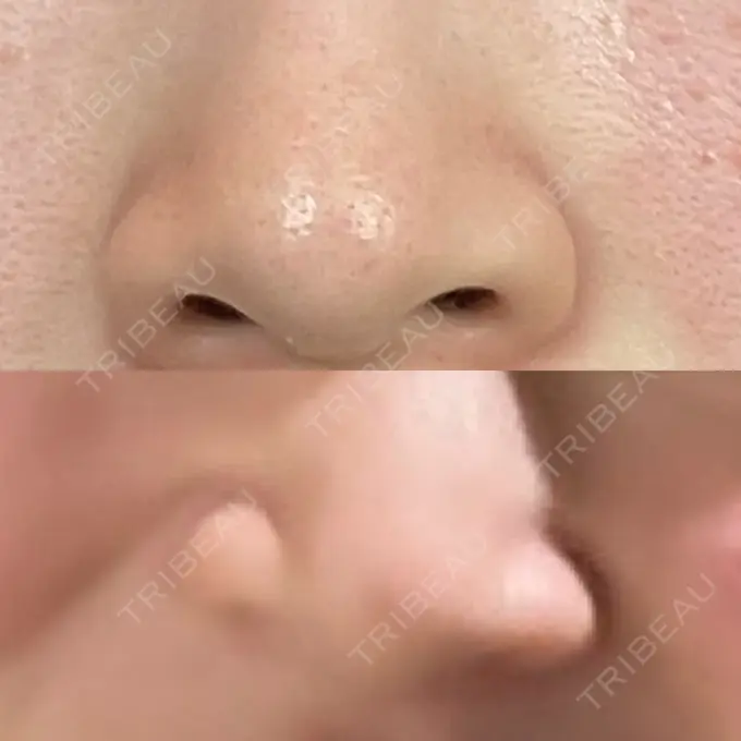 小鼻縮小（切開） 銀座S美容・形成外科クリニック BEFORE メイン用