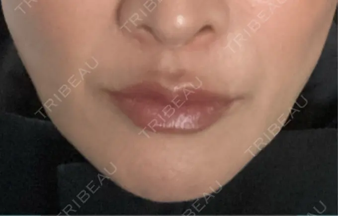 糸リフト / ヒアルロン酸注入（鼻翼基部） / リジュラン Brandnew Beauty Clinic BEFORE メイン用