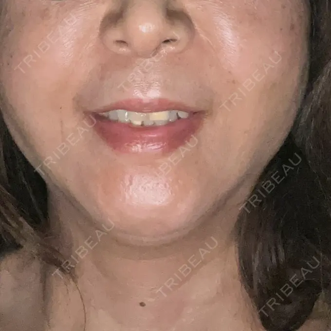 糸リフト / 肌ヒアルロン酸注入（たるみ・シワ改善） / ボトックス（エラ・小顔） TCB東京中央美容外科 川越院 BEFORE メイン用