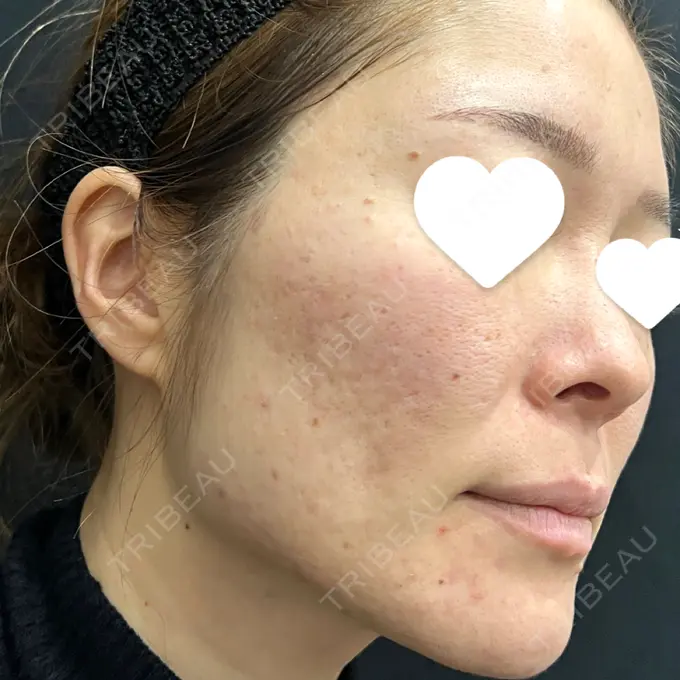 サブシジョン 藤・ナチュレ美容クリニック 銀座院 BEFORE メイン用