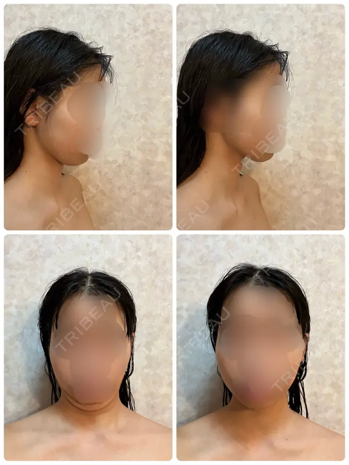 脂肪吸引（顔） / 脂肪吸引（脚） Mods Clinic（モッズクリニック） 名古屋院 BEFORE メイン用