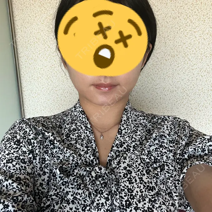 脂肪吸引（顔） / 脂肪吸引（二の腕） 湘南美容クリニック Regno 銀座院 BEFORE メイン用