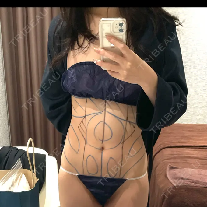 脂肪吸引（顔） / 脂肪吸引（お腹） / 豊胸（脂肪注入） / 乳輪縮小 Mods Clinic（モッズクリニック） 名古屋院 BEFORE メイン用