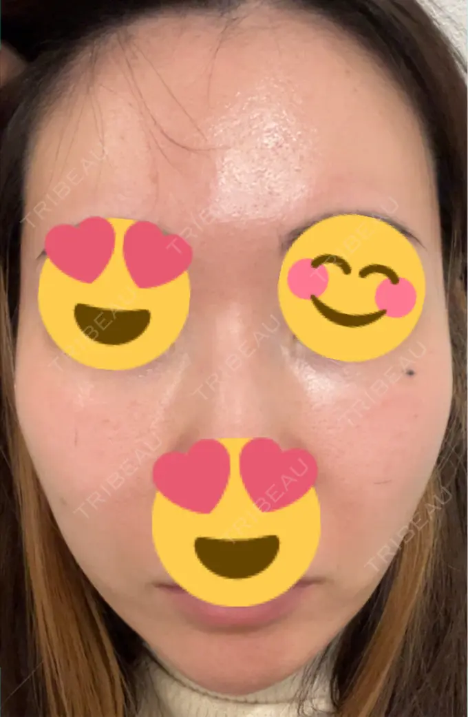 ピーリング（ニキビ・毛穴） / ヴェルヴェットスキン / ピーリング（ハリ・ツヤ） ミニマムスキンクリニック池袋 BEFORE メイン用