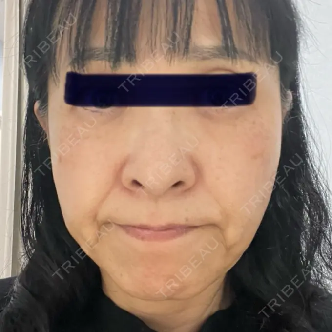 糸リフト / ボトックス（あご） / ヒアルロン酸注入（あご） / ヒアルロン酸注入（唇） / シワ取りボトックス / ヒアルロン酸注入（鼻翼基部） / その他（目元） ルラ美容クリニック 仙台院 / ルラスキンクリニック 仙台院 BEFORE メイン用