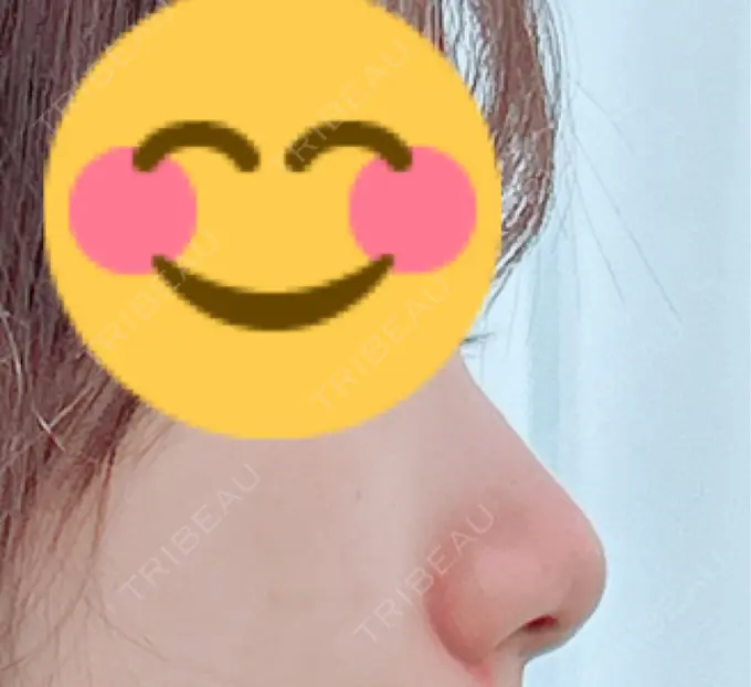 鼻尖形成（切開） / 軟骨移植 / 鼻翼挙上 / 鼻修正 / その他（鼻） 東京シンデレラ美容外科 大宮院 BEFORE メイン用