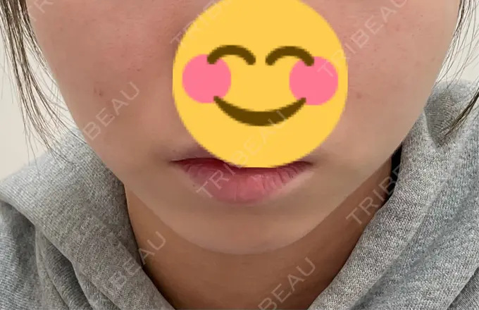 ボトックス（エラ・小顔） / 脂肪溶解注射（顔） 仙台N美容クリニック BEFORE メイン用