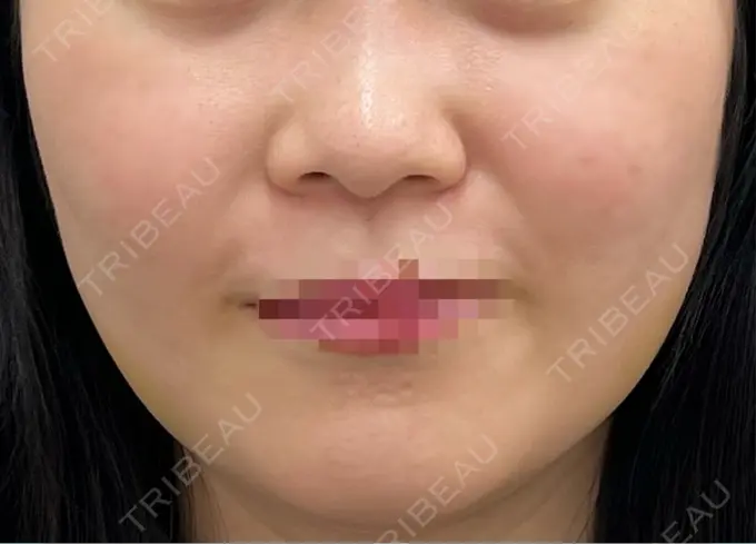 RF（高周波）たるみ治療 東京美容医療クリニック 池袋院 BEFORE メイン用