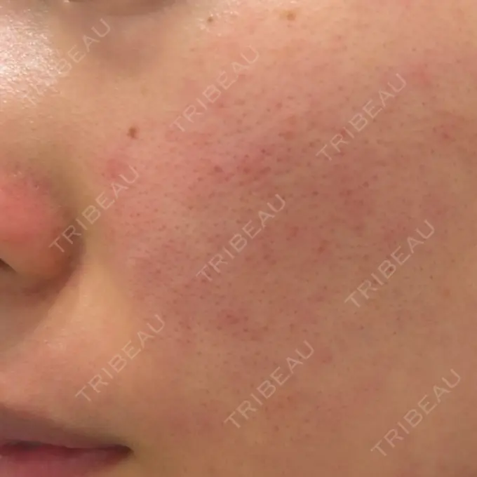 イオン導入 / ピコレーザートーニング（美白・肝斑） / フラクショナルレーザー（毛穴・ニキビ跡） ルラ美容クリニック 横浜院 BEFORE メイン用