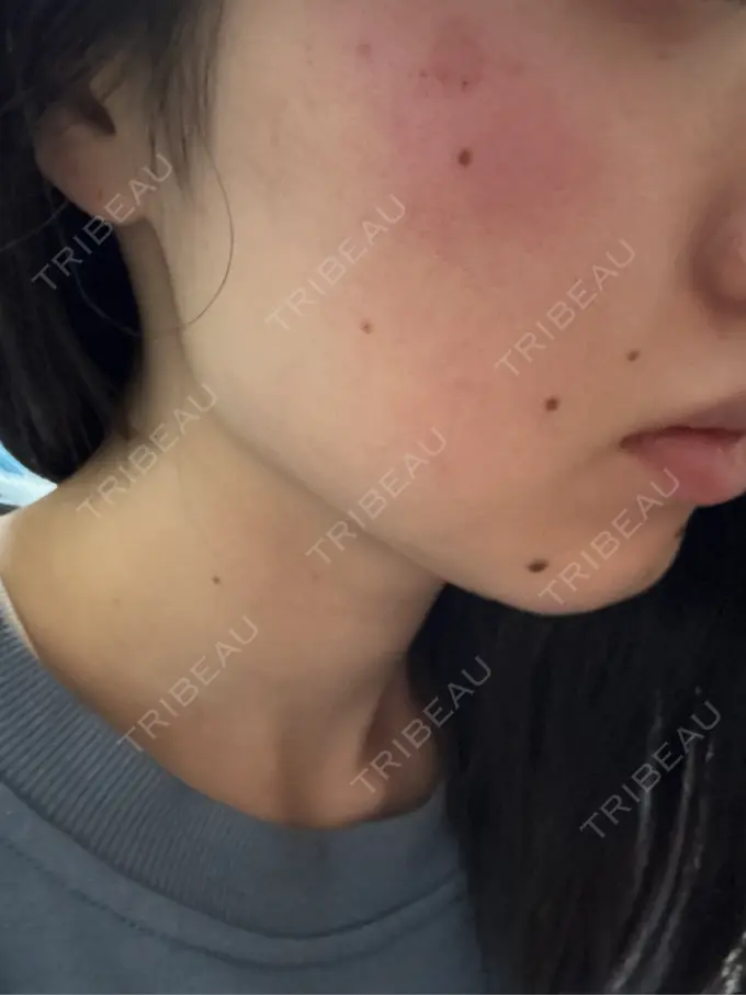 シミ取りレーザー / ピコスポット BISIN GINZA CLINIC BEFORE メイン用