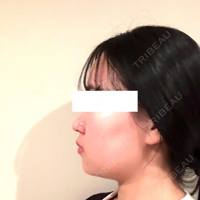 脂肪吸引（顔） / ボトックス（エラ・小顔） Mods Clinic（モッズクリニック） 名古屋院 BEFORE メイン用