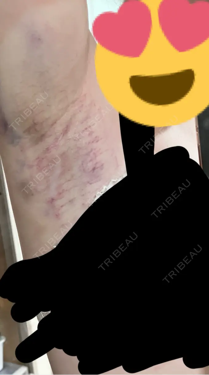 ワキ汗治療（レーザー） Fellez Clinic【フェルズクリニック】 BEFORE メイン用