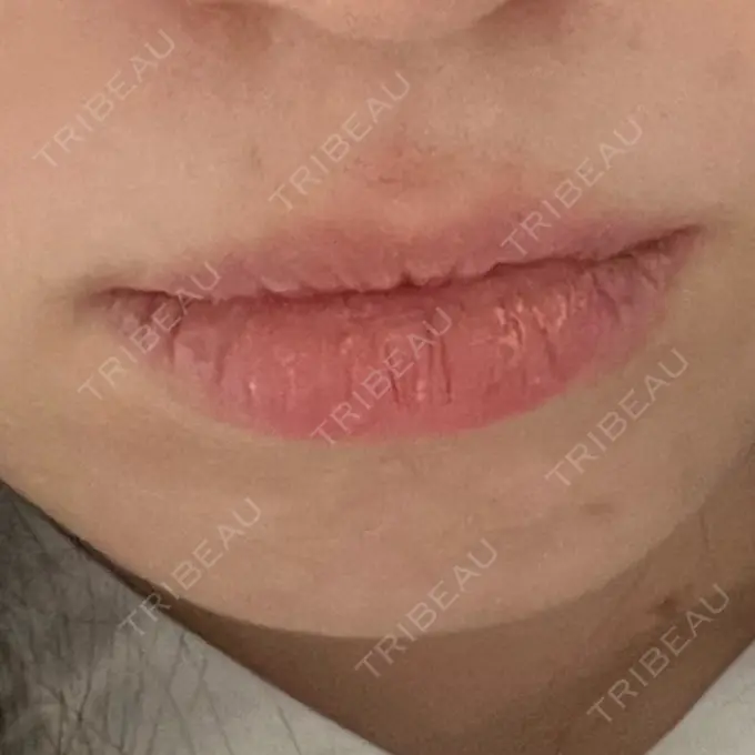 ヒアルロン酸注入（あご） / ヒアルロン酸注入（唇） / ボトックス（口角） ルラ美容クリニック 高田馬場院 BEFORE メイン用