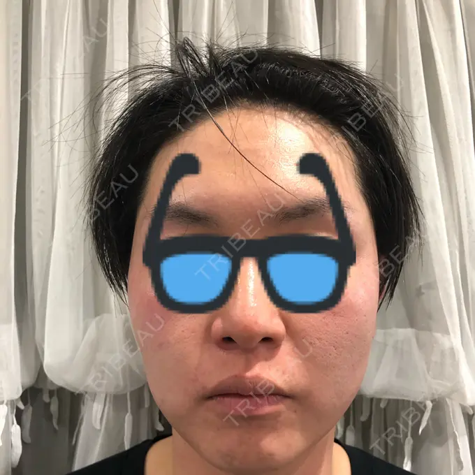 ボトックス（エラ・小顔） おおたかの森ビューティークリニック BEFORE メイン用