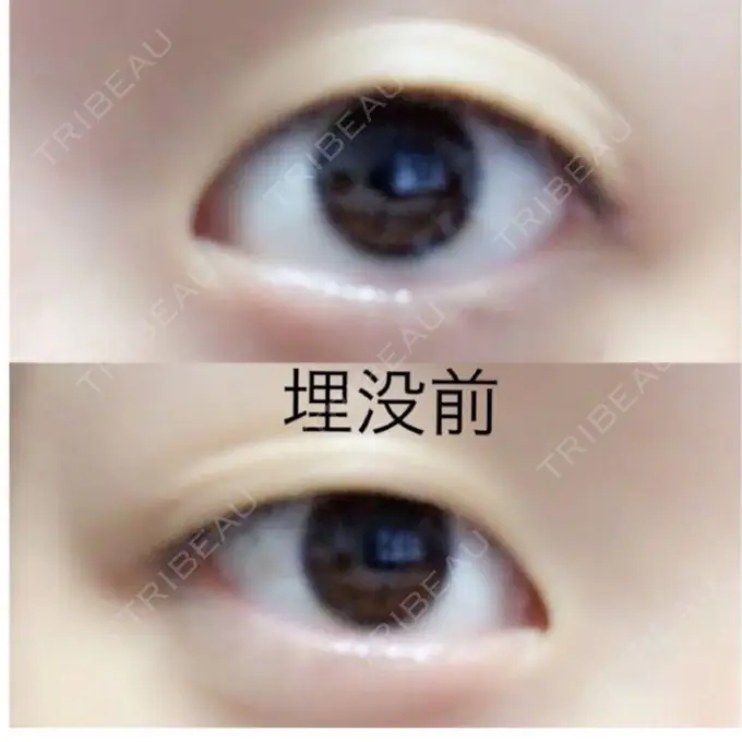 二重埋没 ルネッサンス美容外科医院 神戸院 BEFORE メイン用