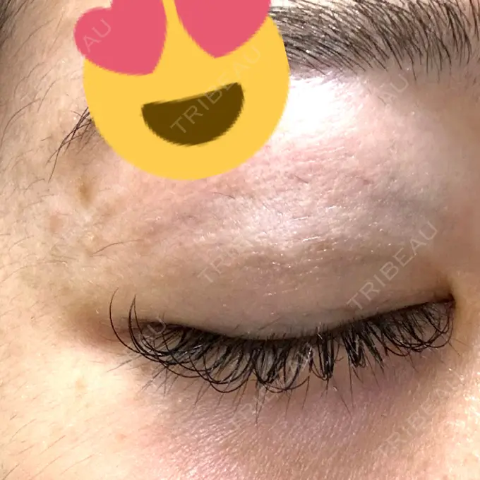 上まぶたの脂肪取り HAAB×DREAM BEAUTY CLINIC 大阪梅田院 BEFORE メイン用