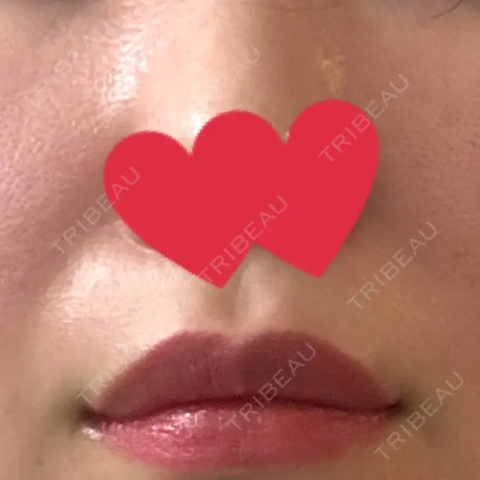 ヒアルロン酸注入（鼻翼基部） THE FIRST CLINIC 町田院 BEFORE メイン用