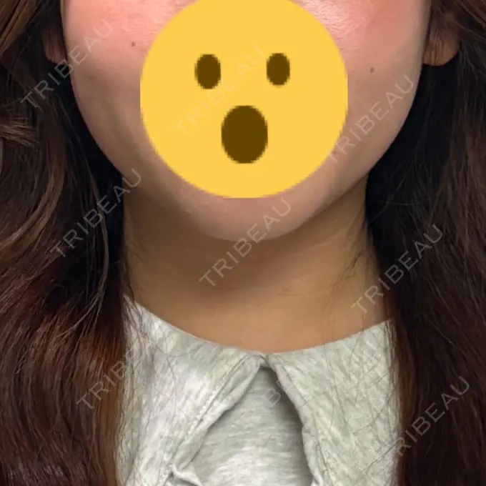 RF（高周波）たるみ治療 大美会クリニック 心斎橋本院 BEFORE メイン用