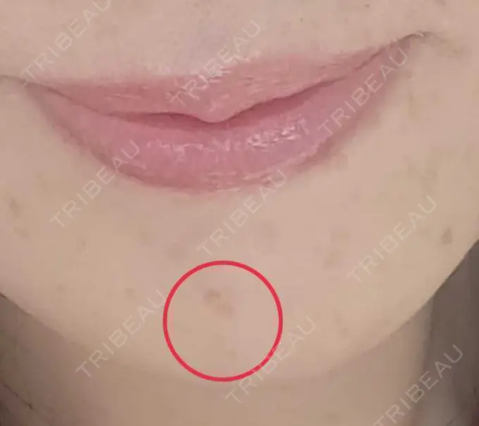 イオン導入 / シミ取りレーザー 湘南美容クリニック 仙台院 BEFORE メイン用