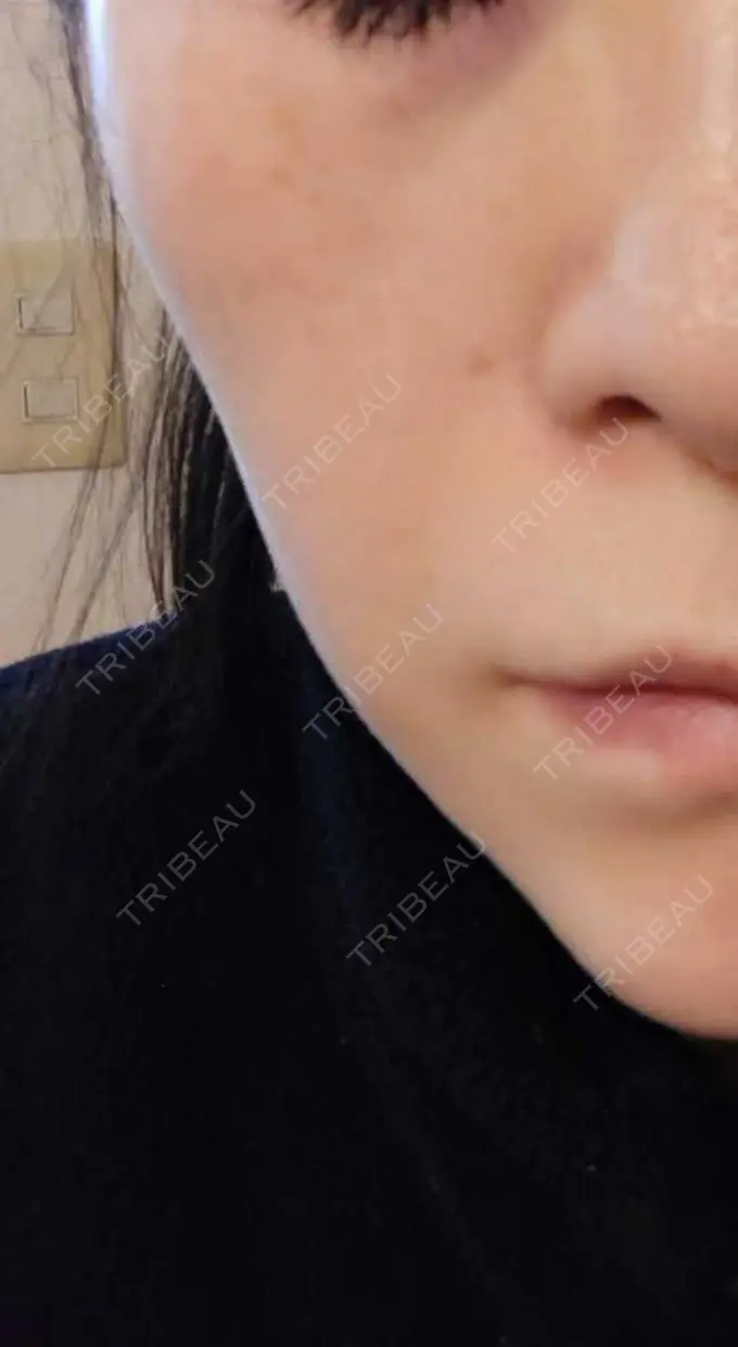 肌育注射（ジュベルックなど） おおしま皮膚科 BEFORE メイン用