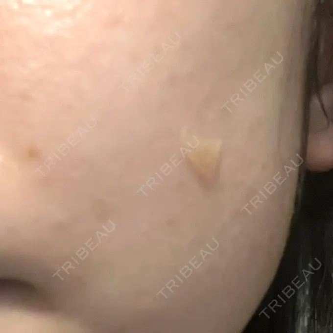 ほくろ・いぼ除去レーザー（肌） Mavie Beauty Clinic （マヴィービューティークリニック） BEFORE メイン用