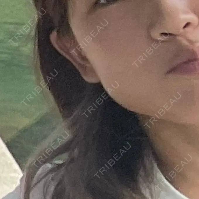 ボトックス（エラ・小顔） TCB東京中央美容外科 大分院 BEFORE メイン用