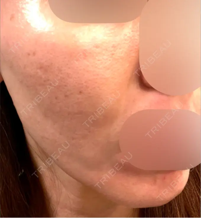 医療脱毛（顔） しんゆり美容健康クリニック BEFORE メイン用