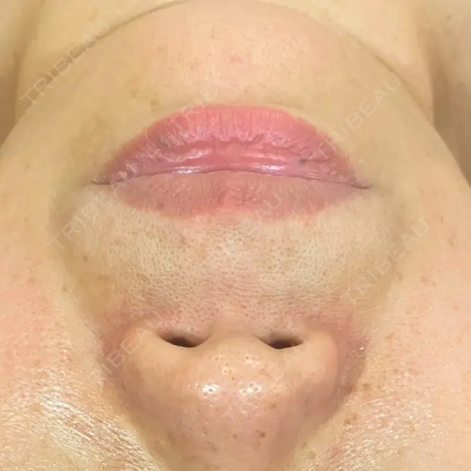 ヒアルロン酸注入（鼻） / ヒアルロン酸注入（あご） / ヒアルロン酸注入（頬） / ヒアルロン酸注入（こめかみ） KIMI CLINIC 形成・美容外科 BEFORE メイン用