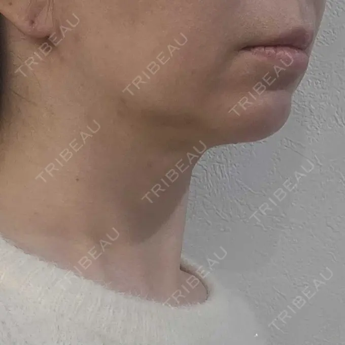 ボトックス（あご） / ボトックス（エラ・小顔） / その他（鼻） TCB東京中央美容外科 横浜駅前院 BEFORE メイン用