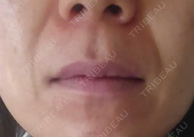 ボトックス（あご） / ボトックス（口角） MAクリニック 心斎橋 BEFORE メイン用