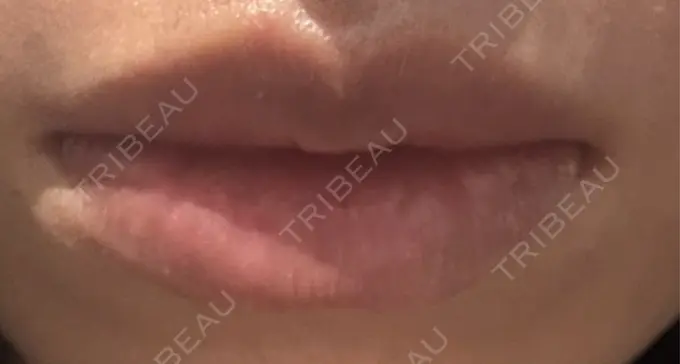 ヒアルロン酸注入（唇） Code Beauty Clinic 名古屋院 BEFORE メイン用