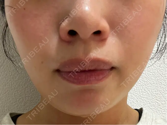 ボトックス（エラ・小顔） L‘amour clinic Tokyo【ラムールクリニック東京】 BEFORE メイン用