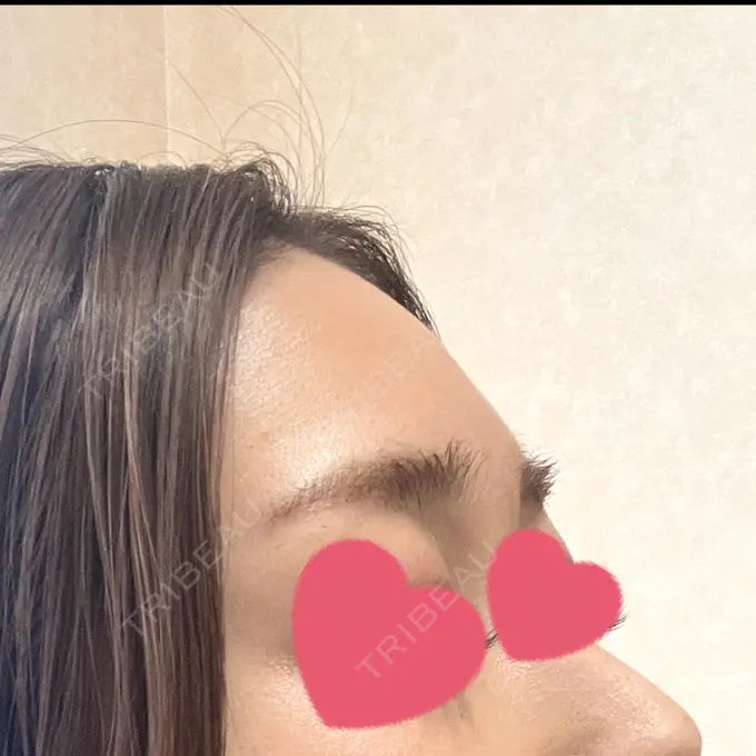 ヒアルロン酸注入（額） B-LINE CLINIC 大阪院 BEFORE メイン用