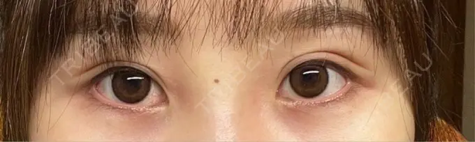 アートメイク（アイライン） Kinshicho Beauty Clinic （錦糸町ビューティークリニック） BEFORE メイン用