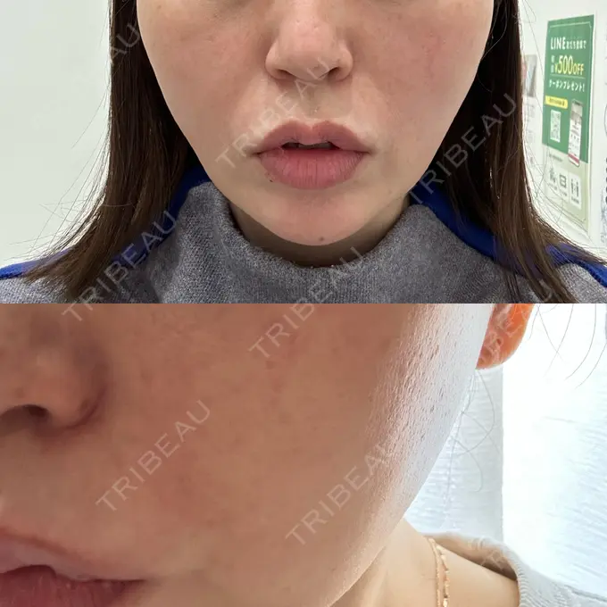 ピーリング（ハリ・ツヤ） ルラ美容クリニック 名古屋栄院 / ルラスキンクリニック 名古屋栄院 BEFORE メイン用